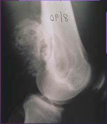 PAROSTEAL OSTEOSARCOMA Well differentiated OS that arises on the bone surface and appears as a heavily mineralized