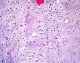 recurrence CHONDROSARCOMA Grade 1: small nuclei (>8 micron), binucleation, chondroid matrix, rare myxoid areas Grade 2: