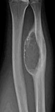 ANEURYSMAL BONE CYST Benign lesion with cyst-like walls Up to 50% are secondary to