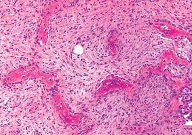 OSTEOFIBROUS DYSPLASIA Hopefully: Fundamentals of neoplastic bone pathology