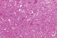 GIANT CELL OSTEOSARCOMA