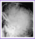Bone Cyst Enchondroma Fibrous Dysplasia ECCENTRIC