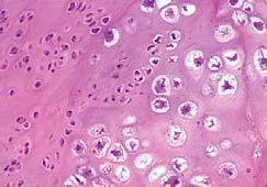 periosteum CLEAR CELL CHONDROSARCOMA M