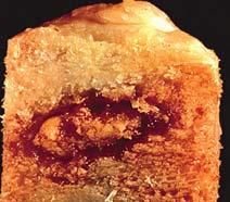 OSTEOID OSTEOMA Small, oval, cortical radio-lucency with variable mineralization Sclerosis and