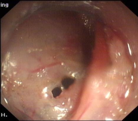 Sufficient submucosal