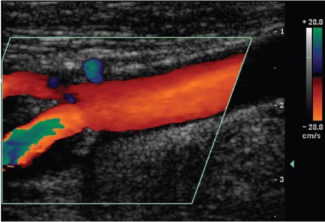 Color Doppler Maps mean blood velocity at each points and encodes it in color on the