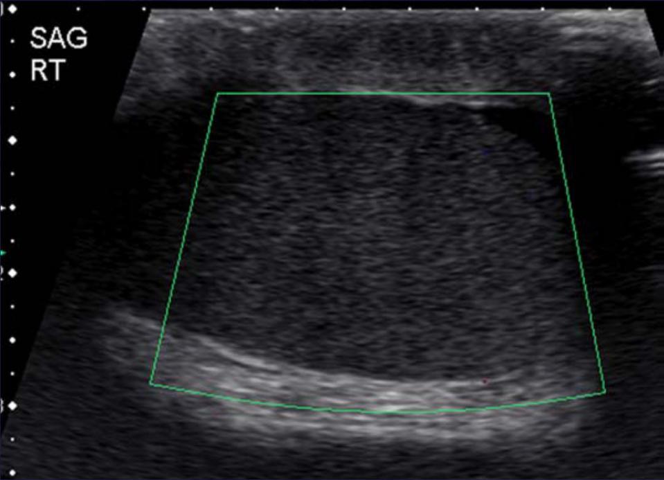 Testicular Torsion: Gray scale Color flow Doppler of the right testis in the longitudinal plane