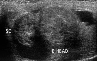 Testicular Torsion: Gray scale Enlarged