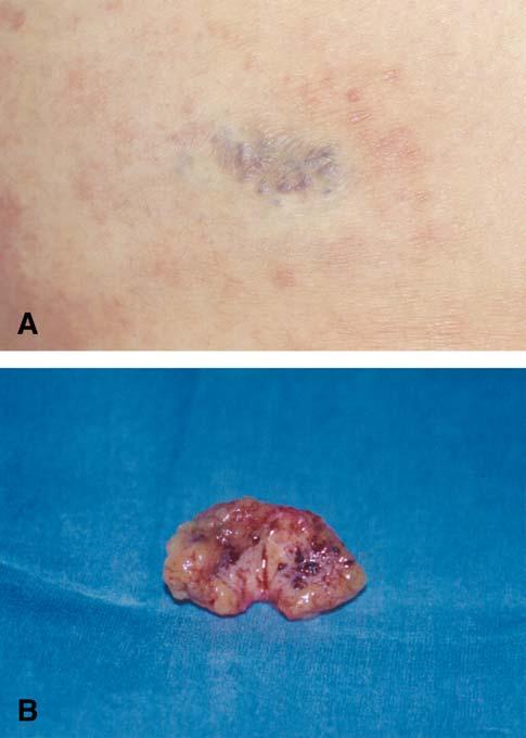 168 Case reports JAM ACAD DERMATOL JANUARY 2006 Fig 2. Magnetic resonance image findings of subcutaneous nodule. T1-weighted (A), T2-weighted (B), and gadolinium-enhanced (C and D) images. Fig 1.