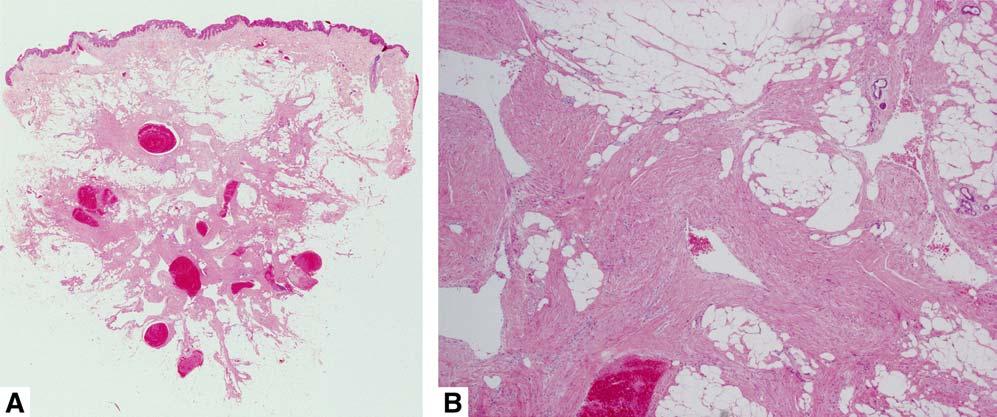 Case reports 169 Fig 3. Histopatology of cutaneous angiolipoleiomyoma at low- (A) and high- (B) magnification views. (A and B, Hematoxylin-eosin stain; original magnifications: A, 320; B, 3100.