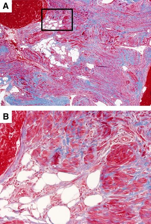 Masson trichrome method stained muscular portions of tumor bright red and stained collagen blue. (Original magnifications: A, 340; B, 3200.