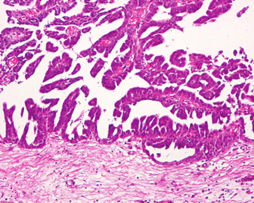 2 Figure 1: Papillary serous carcinoma of peritoneum (PSCP) on hysterectomy.