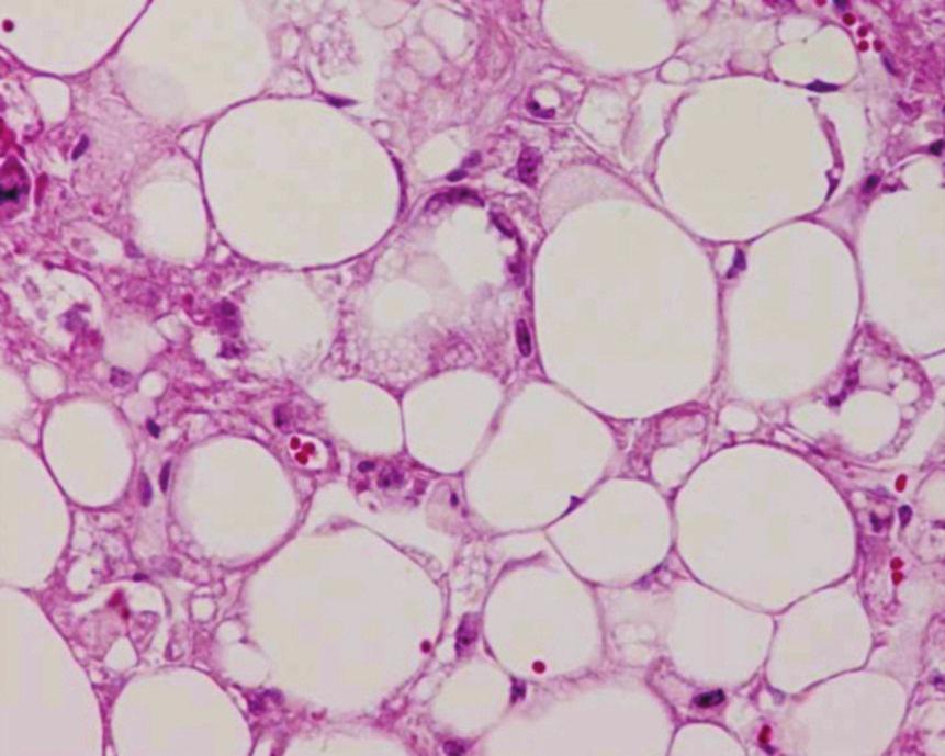 HMB-45 is positive. Figure 4: Papillary serous carcinoma of the peritoneum (PSCP).