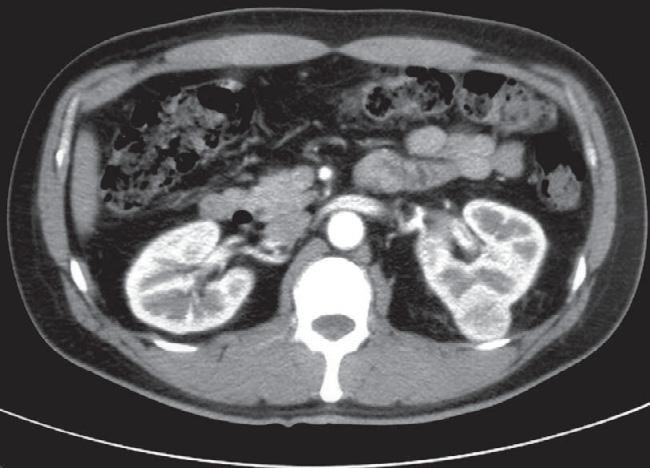 EAML of the kidney mimicking RCC noted on CT scan. None of the lesions contained fat components ( 20 HU) or calcification (Figure 1), but one lesion showed central hemorrhage and necrosis (Case 2).