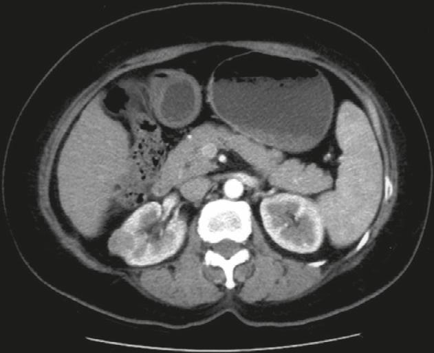 One (Case 3) of the two patients with definitive tuberous sclerosis complex (TSC) had a small conventional AML with fat content in the other kidney (Figure 2).