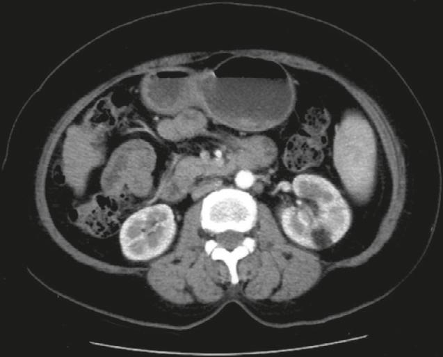 3 cm slightly hypodense and mildly hypervascular nodule was noted, bulging outward from the left renal parenchyma. The left renal tumor was noted accidentally by sonography during a health check-up.