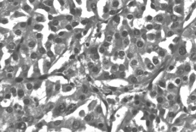 eosin). (C) Neoplastic cells show no cytoplasmic immunoreactivity to cytokeratin. (D) Neoplastic cells show strong cytoplasmic granular immunoreactivity to HMB-45.