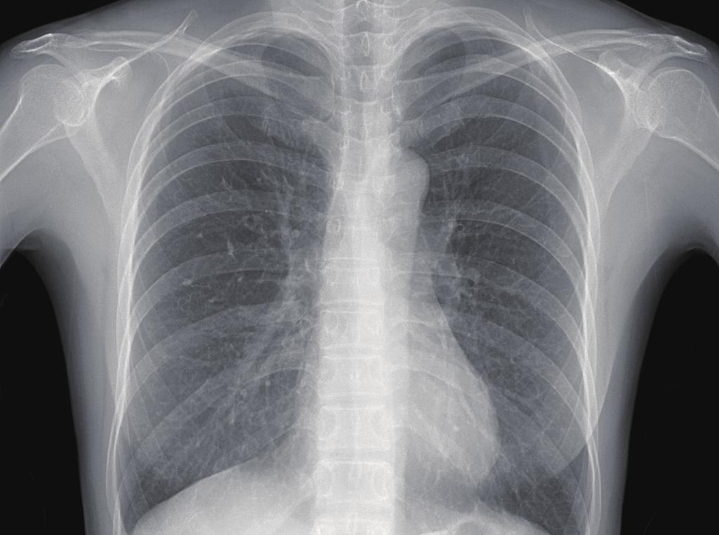 Park HY, et al. Lymphangioleiomyomatosis in Korea tients, two patients underwent lung transplantation.