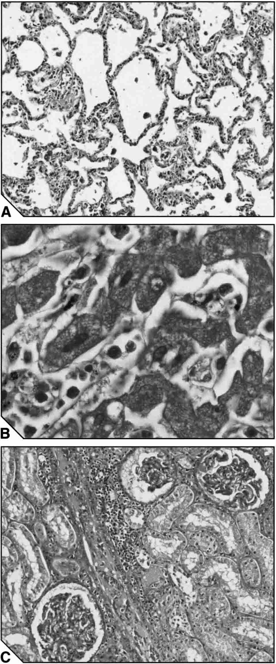 192 OZWARA AND OTHERS mental or diffuse increase in volume of mesangial matrix. Atrophic glomeruli were an occasional finding. No lesions were observed in animals with mild malaria.
