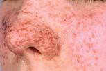 TSC Affects Multiple Organ Systems 1,2 Skin Facial angiofibromas Ash leaf spots Shagreen