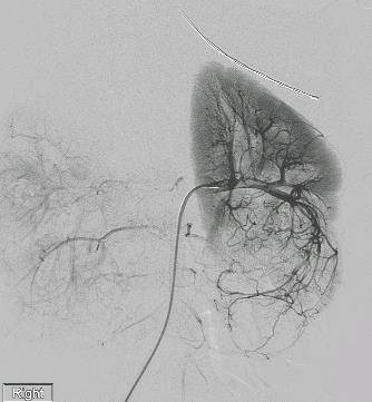 Surgery Should Not be Considered A First-Line Option Renal Embolization for TSC-associated Angiomyolipoma: Limitations Treats single lesions and not