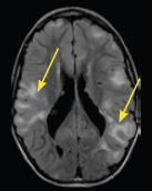 TSC Affects Multiple Organ Systems 1,2 Neurologic Epilepsy 90% Infantile seizures 20-30% Brain tumors - Cortical tubers 90 % - SENs 95% - SEGAs 6-19% Collections of dysmorphic neurons, large