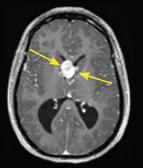 TSC Affects Multiple Organ Systems 1,2 Neurologic Epilepsy 90% Infantile seizures 20-30% Brain tumors - Cortical tubers 90 % - SENs 95% - SEGAs 6-19% A large SEGA along the midline of the brain near