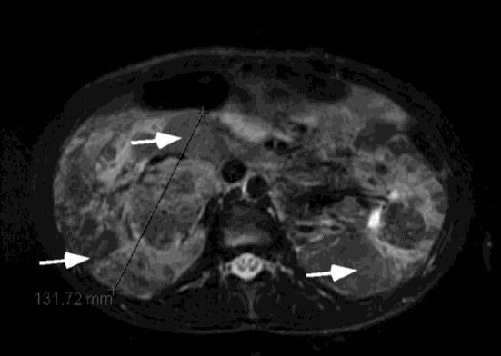 TSC Affects Multiple Organ Systems 1,2 Angiomyolipoma Slow growing, bilateral kidney tumors Complications due to mass effect: hemorrage or rupture of blood vessels feeding the lestion, destruction