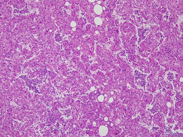 The epithelioid tumor cells had abundant granular eosinophilic cytoplasm,