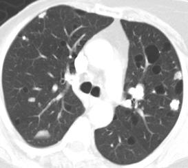 Rare (report of 3 cases) Young women without renal involvement Progressive obstructive respiratory failure Dominant B cell clone restricted to the lung May