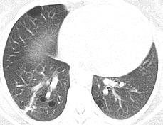 Pathologically the cysts are associated with the peripheral interlobular septa, visceral pleura or septo-pleural junction HRCT findings: Cysts (often large)