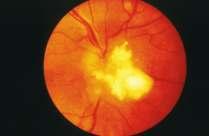 TSC: a multi-system genetic disorder other organ systems Eye