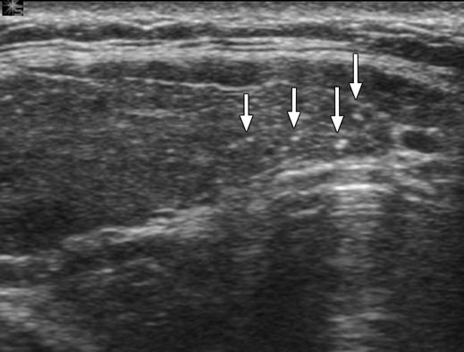 Sonography of Papillary Thyroid Carcinoma tients: two at level IV, one at level II, and one at level VI.
