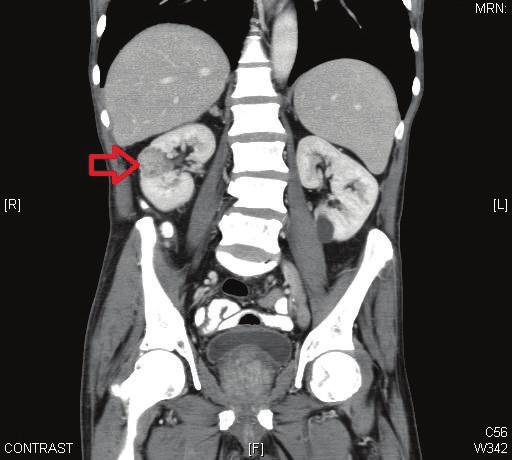 2 Case Reports in Urology Figure 1: Computed tomography of abdomen (coronal view) showing right kidney mid pole mass turned out as renal cell carcinoma upon radical nephrectomy.