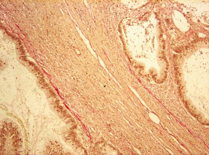 April 2005 ROLE OF DESMOPLASIA IN COLORECTAL CARCINOMA 371 Figure 1. Advancing edge of the tumor. Muscularis propria infiltration with absence of a desmoplastic reaction. Van Gieson 200.