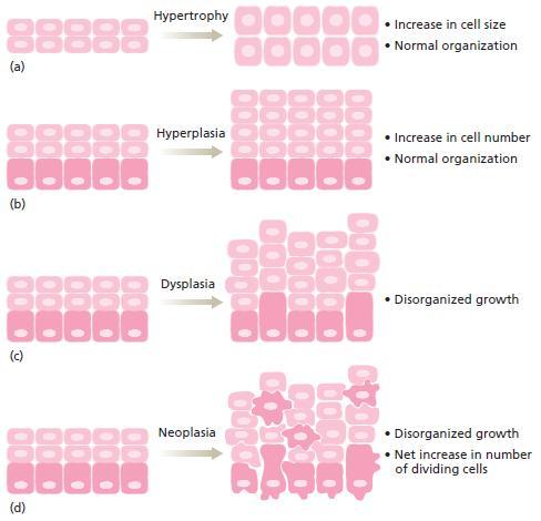 CHAPTER III CANCER CELL Figure 3.7 Types of tissue growth (from Almeida, 2010).