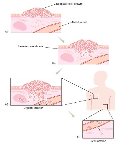 CHAPTER III CANCER CELL undifferentiated cells that are invasive and disruptive to the structure and function of surrounding tissues.
