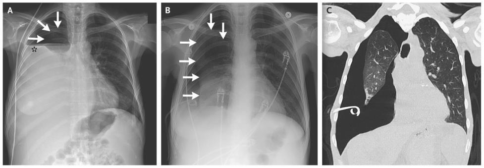 Critical Care pearls for patients with Pleural Disease Take a Timeout if you see a hydropneumothorax post thoracentesis in the ED Secondary to 2 common phenomenon: Pneumothorax Ex Vacuo- phenomenon