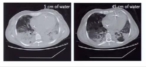 How to choose Optimal PEEP at bedside? 1) Imaging: eg. CT chest 2) Bedside physiology: eg.