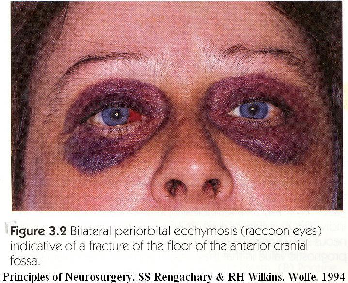 14. What clinical sign is exhibited above?