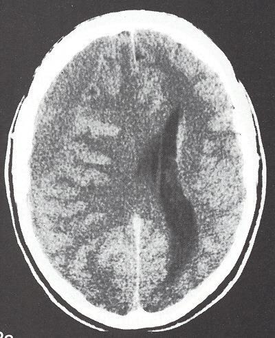 6. What intracranial bleed is represented on the CT scan?