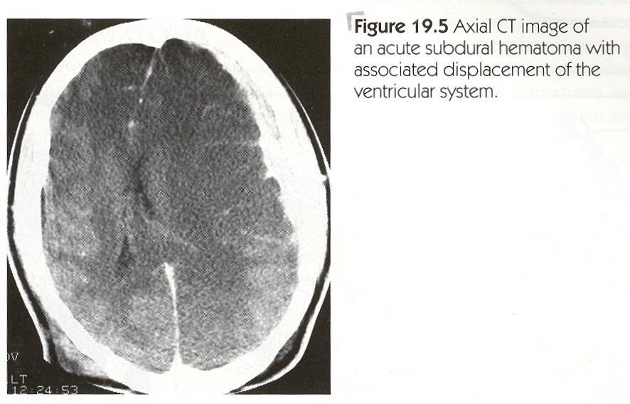 5. What intracranial bleed is represented on the CT scan?