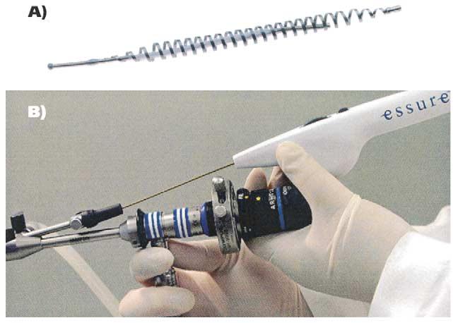 cervical route has been attempted with electrocoagulation, sclerosing substances or tissue adhesives, and mechanical occlusive devices or plugs to block the oviduct, but no method has been widely