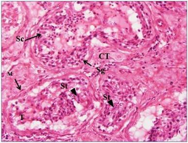 commonly in our study (Figure 7a, 7b). Two of the biopsies showed haphazardly scattered cells which could not be defined, no tubules were seen.