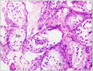 Hypospermatogenesis shown by (H) and maturation arrest by (M). Figure 7b: Mixed patterns: H&E staining in mixed pattern at 40x.