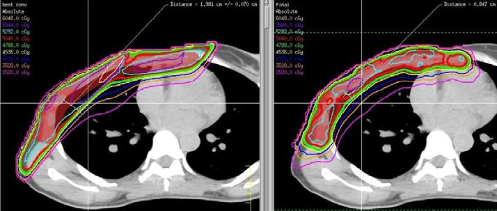 95% 70% 50% 95% 70% 50% 3D Plan IMRT Plan Heart & Lung V 10 Lung V 30 10% Rt Lung