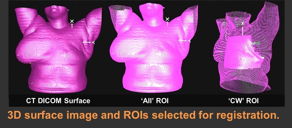 Post-mastectomy chestwall targets expected to be less affected by deformation than breast We investigated the accuracy of 3D surface matching using AlignRT (v4.