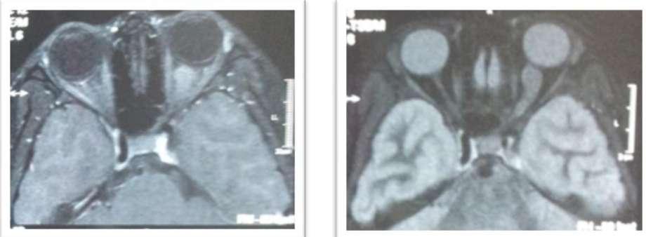 the right eye Fig-5: MRI shows fusiform