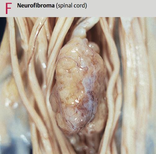 schwannomas of auditory nerve, optic nerve and other