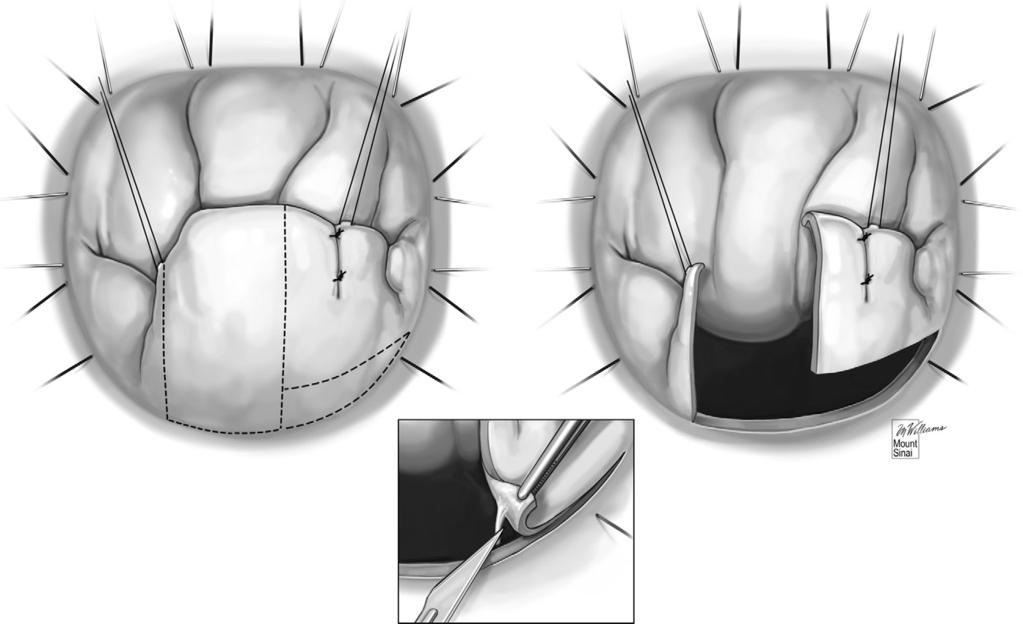 Repairing posterior leaflet prolapse of the mitral valve 305 Figure 12 The excess tissue is asymmetrically favored toward P2 and P3 with a relatively normal looking P1 scallop; we perform a targeted